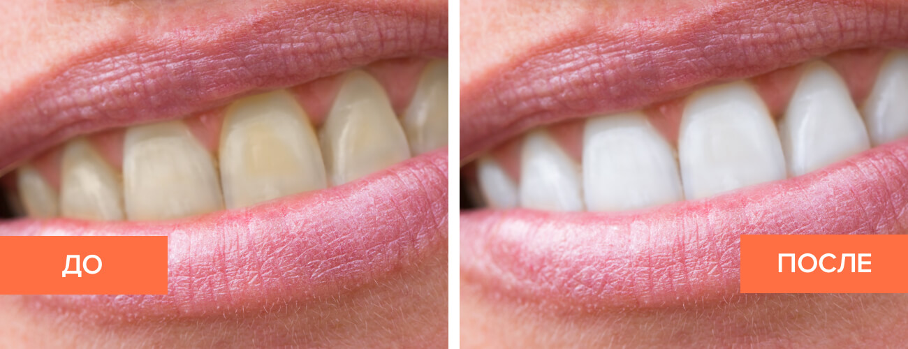 Чистка зубов углем: правильные приемы и рекомендации